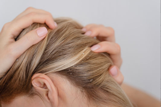 Les meilleures huiles pour lutter contre les pellicules (et celles à éviter)